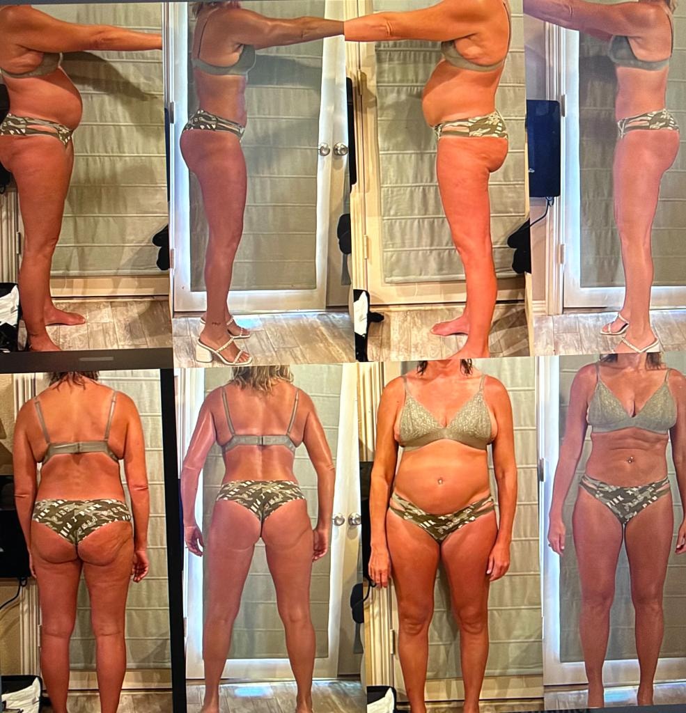 Patient transformation result 16 — Fós Wellness weight loss program